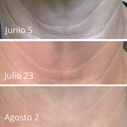Esplenderm Lifting Universal: Efecto Tensor Inmediato en Piel Flácida | Tratamiento No Quirúrgico